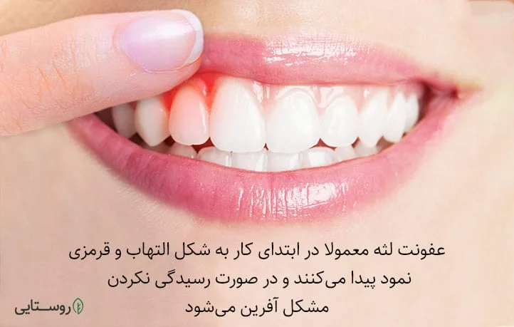 مراحل اولیه عفونت لثه