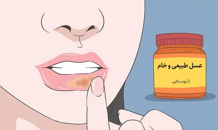 درمان تبخال با عسل