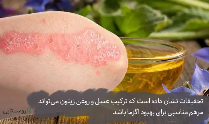 ترکیب روغن زیتون و عسل برای بهبود اگزما