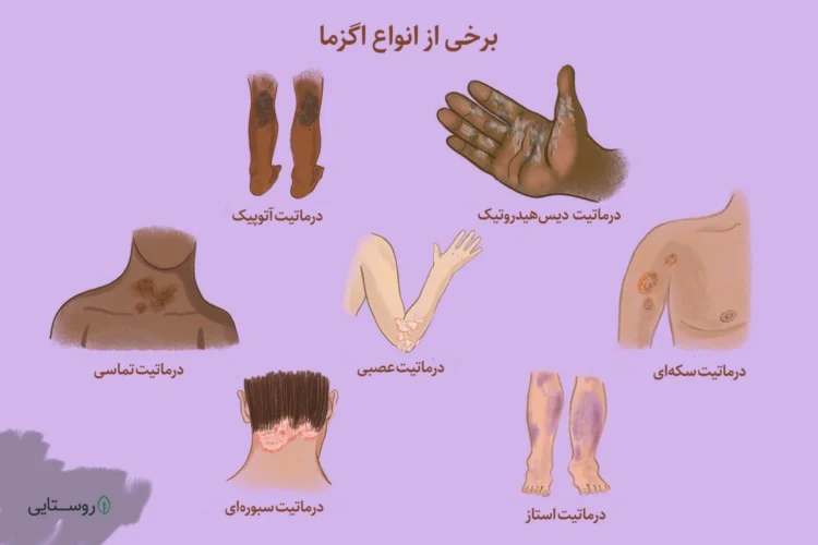 انواع مختلف اگزما